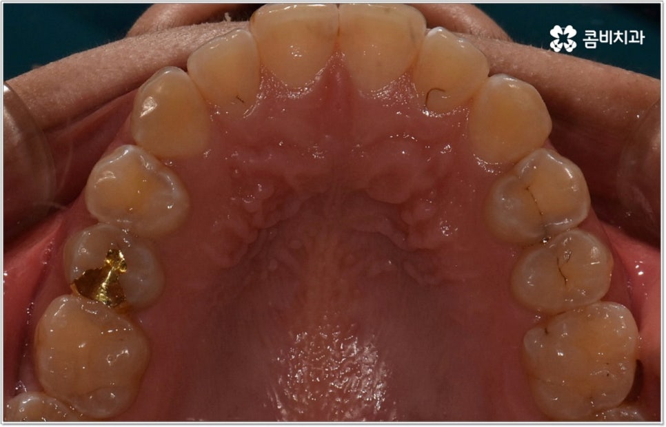비발치치아교정 언제 할수있나요 관련 이미지 5
