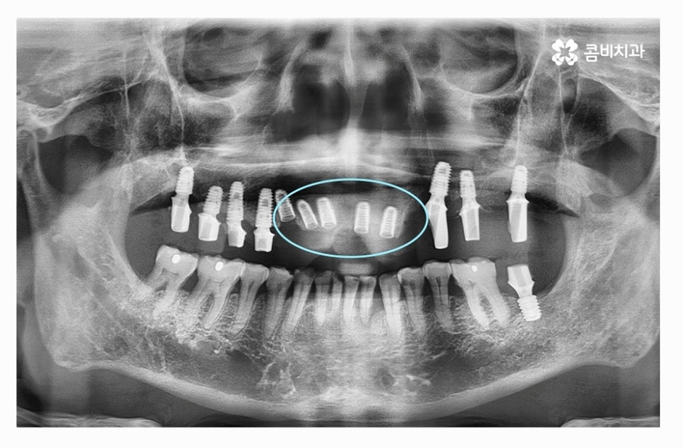 전체임플란트 신중하게 결정하려면 관련 이미지 7