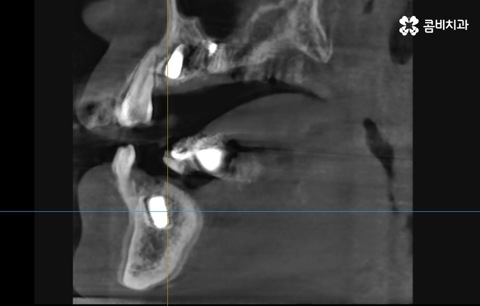 임플란트 치료기간 어느정도 걸리고 치과에는 몇번 가나요 관련 이미지 6