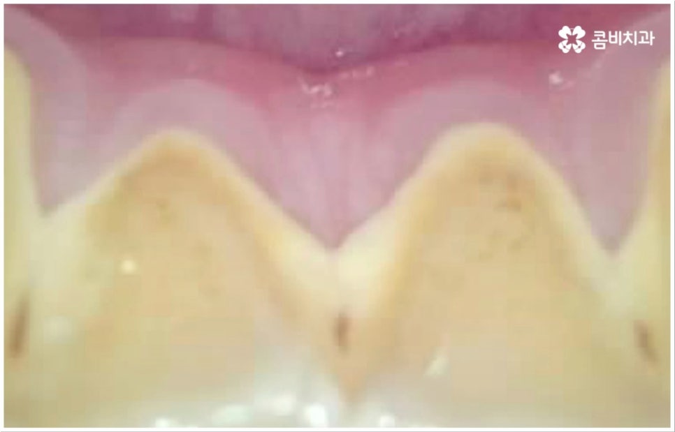 충치 통증 참지마세요 관련 이미지 10