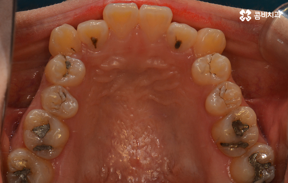 송곳니 덧니 뽑지 않고 해결된 사례 관련 이미지 4
