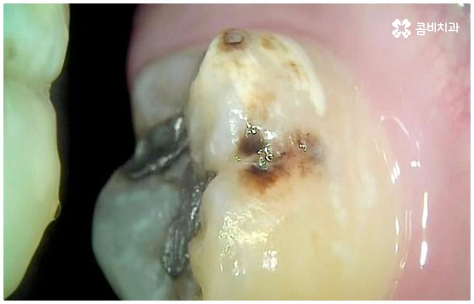 어금니충치치료 아프다면 빨리 관련 이미지 3