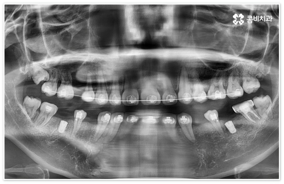 신경치료통증 무섭다고 미루면 관련 이미지 11
