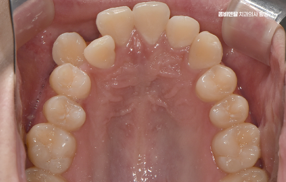 송곳니 덧니 발치 이럴때 해당되네요 관련 이미지 6
