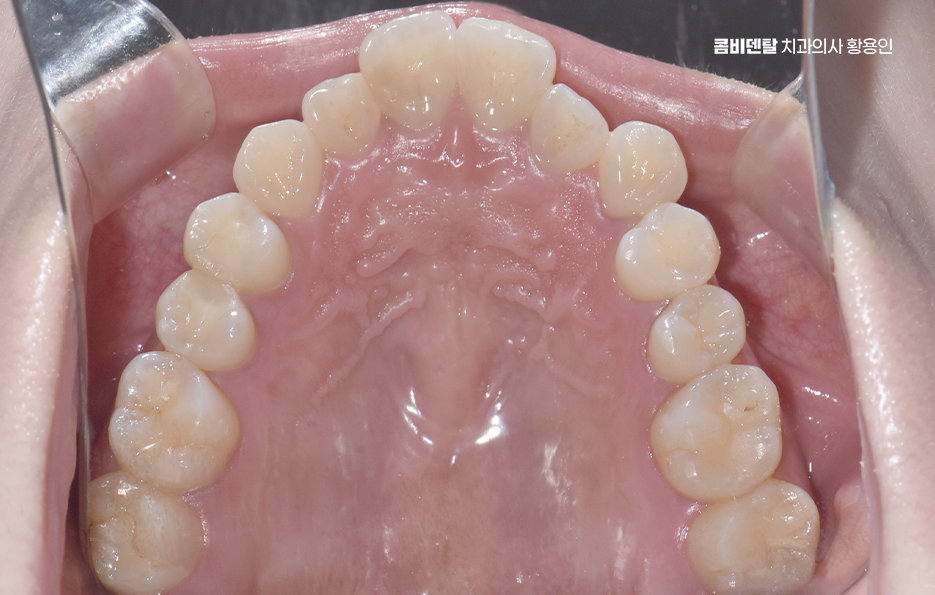 Could the Cause of Protruding Front Teeth Make a Difference? image 6