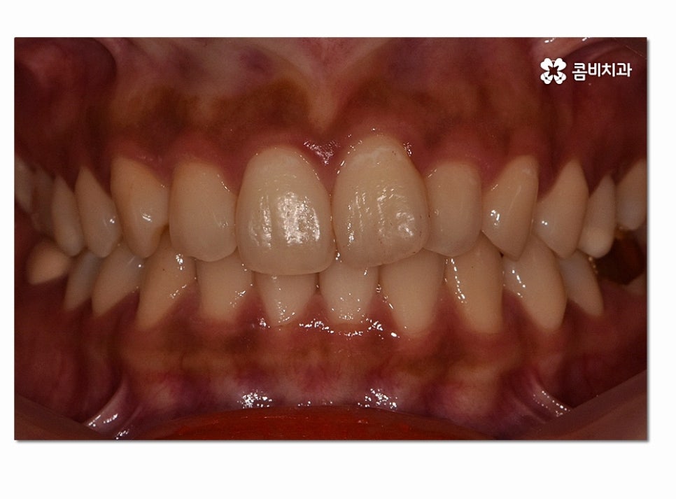 앞니 부분교정 오래 걸리지 않고 원하는 부위만 관련 이미지 1