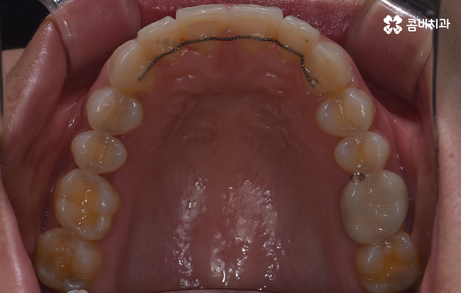 앞니 틀어짐 교정 방법 이럴때는 좀더 간단해요 관련 이미지 8