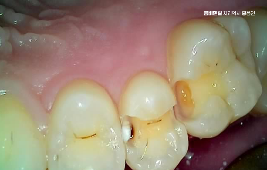 충치치료 아픈가요 미리 알고 예상하려면 관련 이미지 10