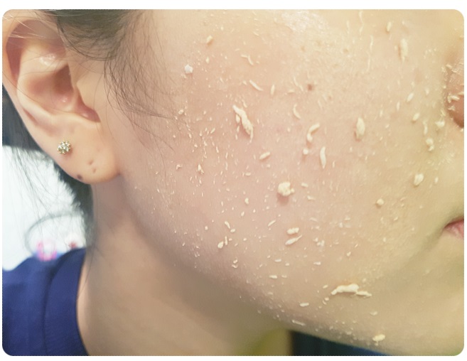 얼굴피지제거 놓치지 말아요 관련 이미지 8