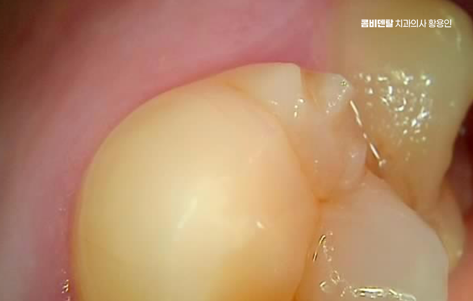 아말감 교체 레진 인레이 어떻게 대처하면 될까 관련 이미지 8