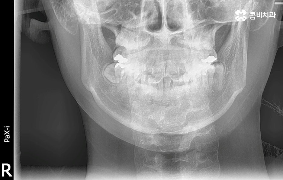 앞니 돌출 어떻게 고치나요? 관련 이미지 1