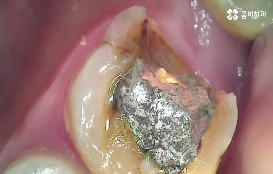충치 단계 어떻게 분류하고 치료해야 하나요 관련 이미지 9