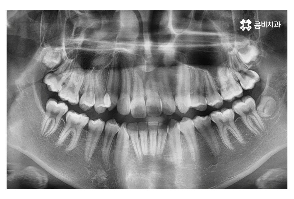 중학생치아교정 세심하게 체크하려면 관련 이미지 4