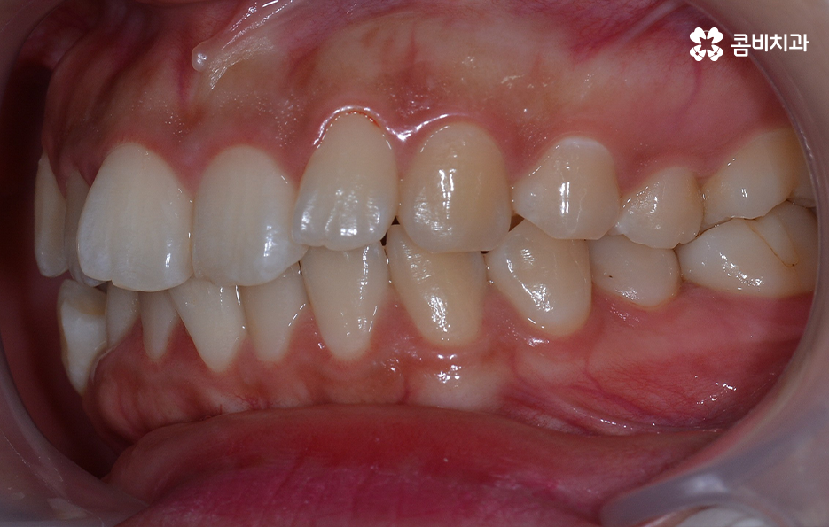 덧니 발치 교정 이런 경우에는 필요합니다 관련 이미지 5