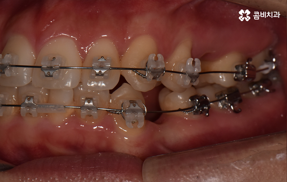 덧니 발치교정으로 교정할 때 치아가 이렇게 이동해요 관련 이미지 9