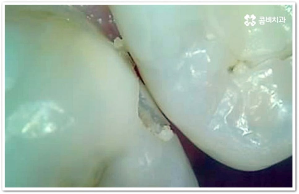 인접면 충치 어떻게 하나요 관련 이미지 5