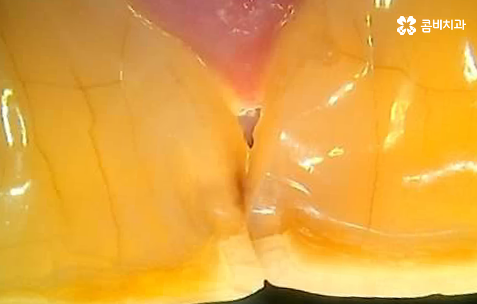 노인임플란트 이때부터 특히 조심하세요 관련 이미지 5