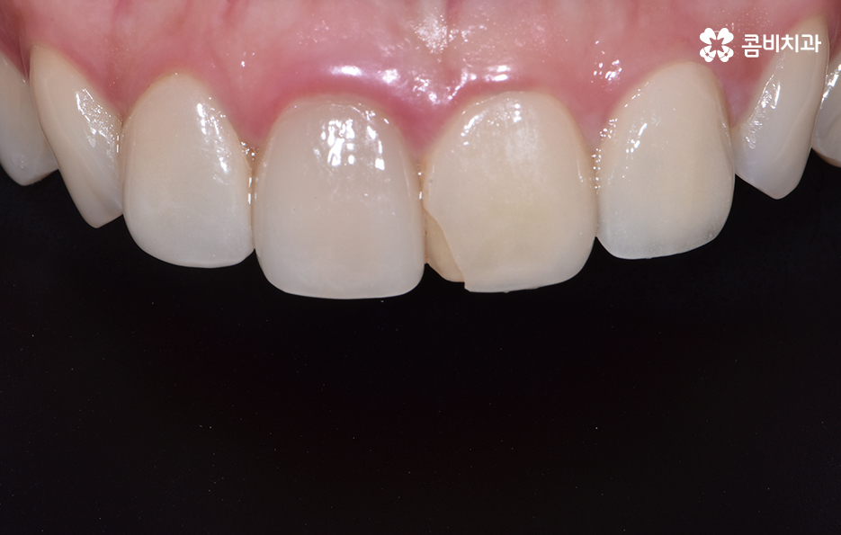 앞니 충치치료 개인에 따라 달라지는 이유 관련 이미지 9