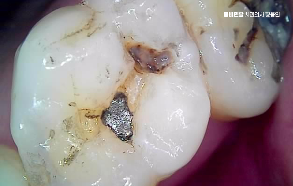 치아 시림 통증 갈수록 심해지다면 관련 이미지 9