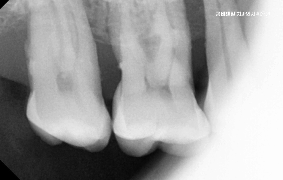 어금니 발치후 임플란트 안하면 어떻게 변하는걸까 관련 이미지 2