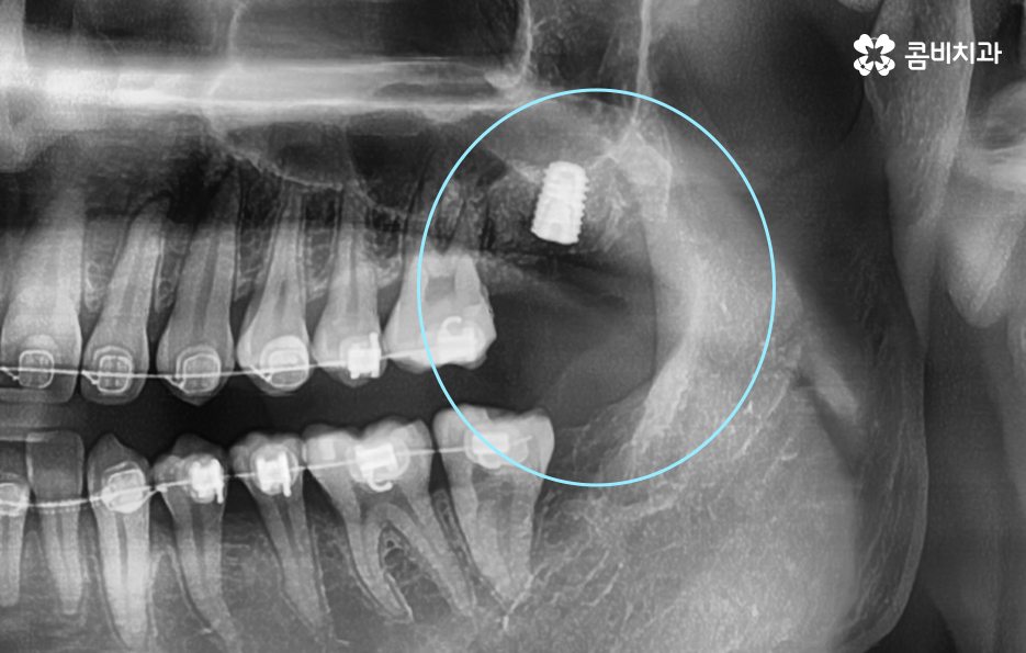 어금니 발치후 임플란트 이런점을 주의합시다 관련 이미지 6