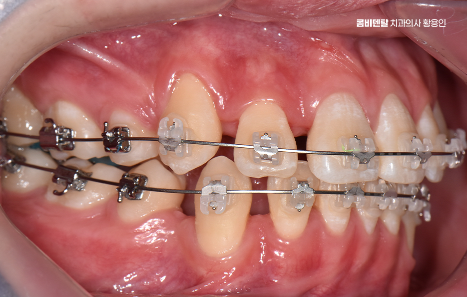 송곳니 덧니 발치 이럴때 해당되네요 관련 이미지 11