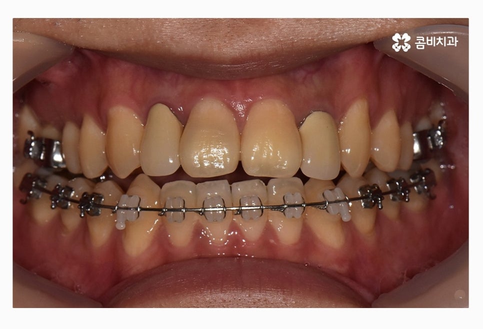 콤비교정 올바르게 판단하려면 관련 이미지 11