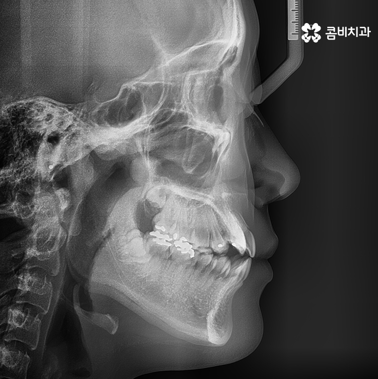 송곳니 덧니 뽑지 않고 해결된 사례 관련 이미지 7