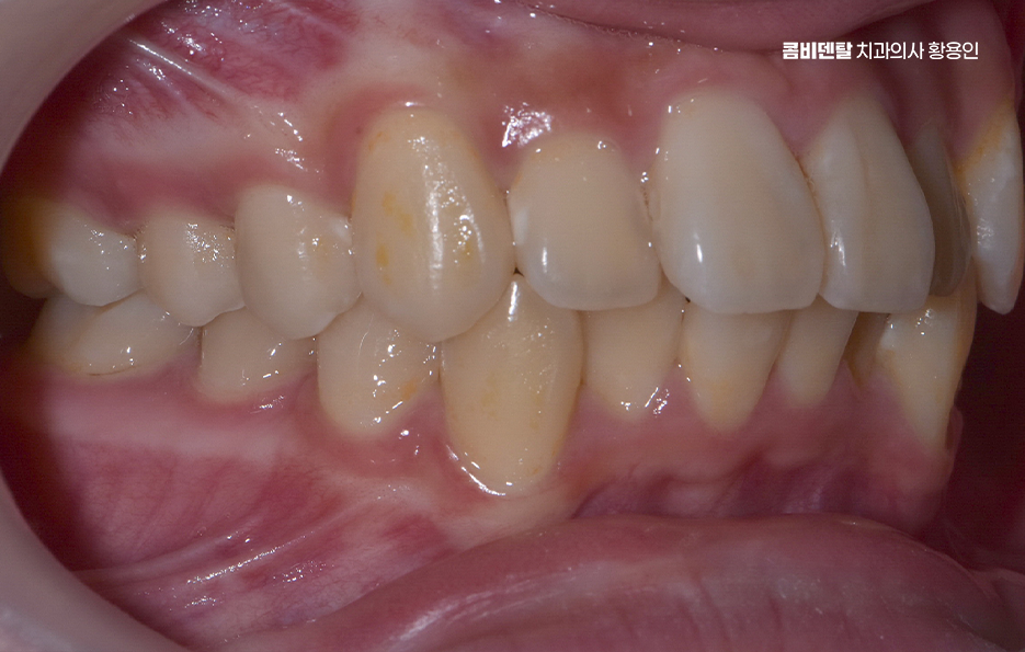 부정교합 교정 안하면 생기는 문제는 뭔가요 관련 이미지 2