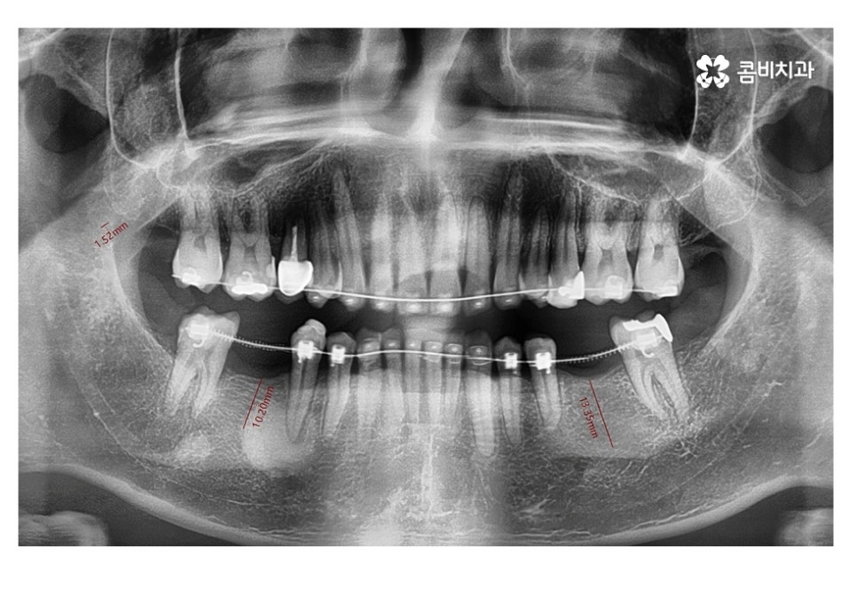 20대임플란트 잦아지는 이유를 알아본다면 관련 이미지 10