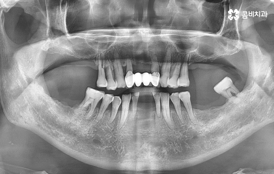50대임플란트 각별하게 주의해야 하는 시기 관련 이미지 1