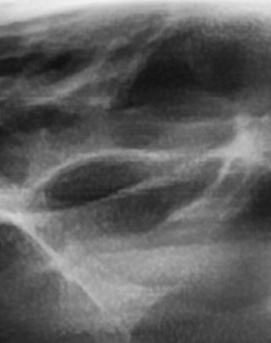 어금니 뒤 잇몸 부음 어떤 문제길래 이런거죠 관련 이미지 11