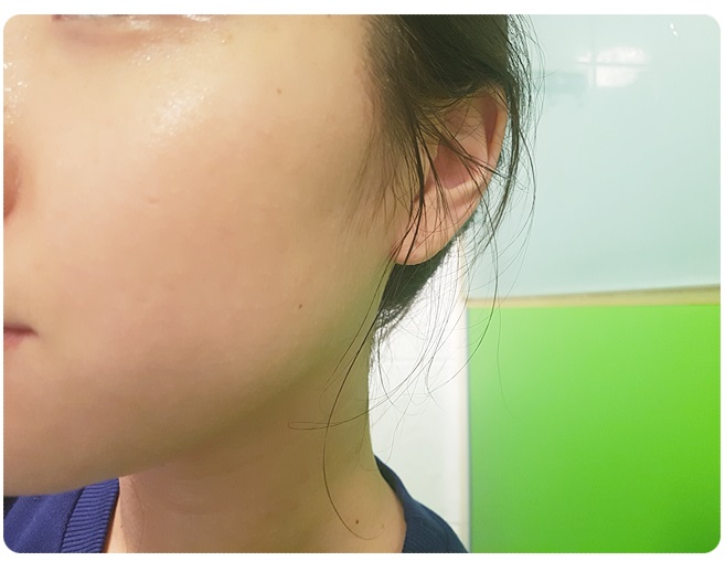 얼굴피지제거 놓치지 말아요 관련 이미지 9