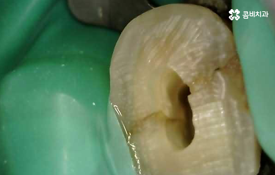 신경치료 아픈가요 핵심 위주로 요약했어요 관련 이미지 15