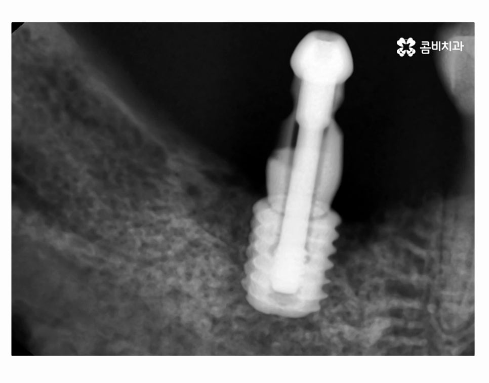 어금니 발치 심각해지기 전에 막으려면 관련 이미지 12