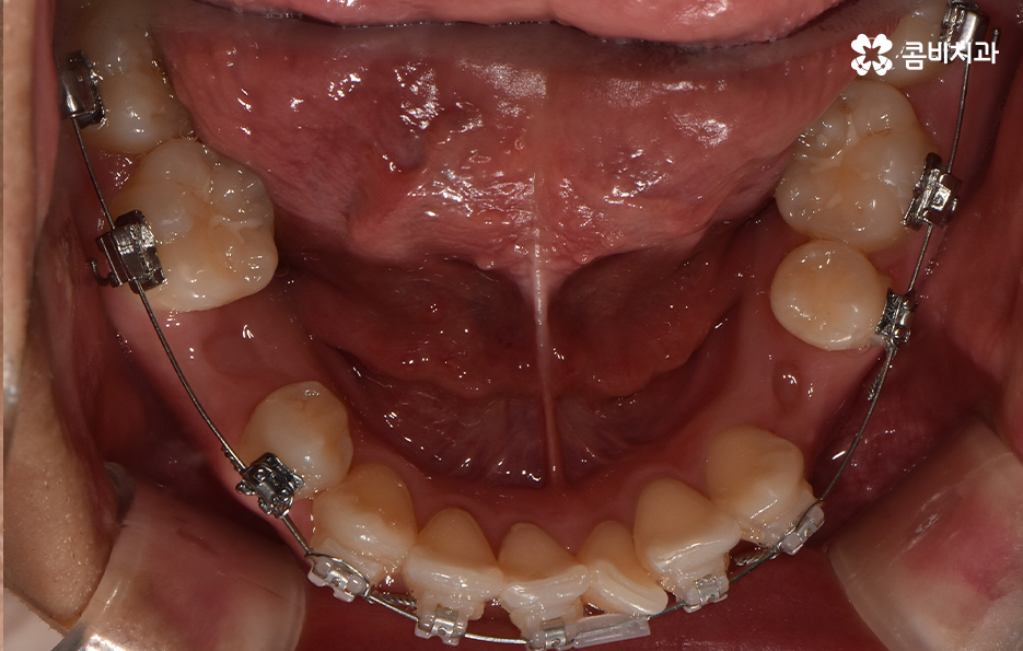 덧니 발치교정으로 교정할 때 치아가 이렇게 이동해요 관련 이미지 12