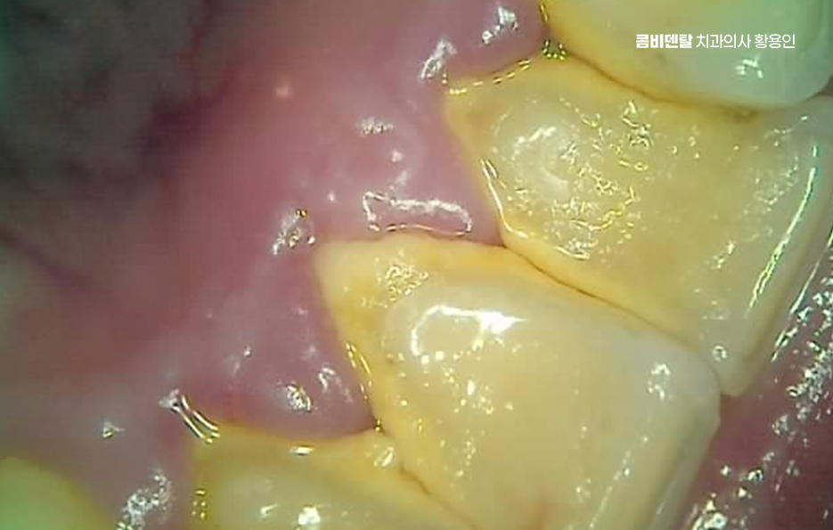 어금니 충치 단계 미리 알아차리려면 관련 이미지 9