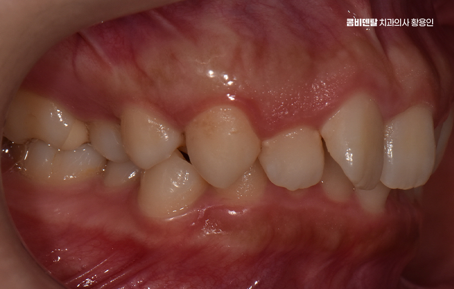 비발치 돌출입 교정 어떨때 적절할까 관련 이미지 3