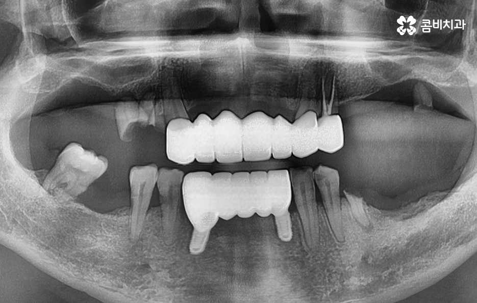 치주염 발치 이렇게나 심각하네요 관련 이미지 11