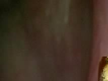 어금니 임플란트 수명 어느정도나 지속될까 관련 이미지 10