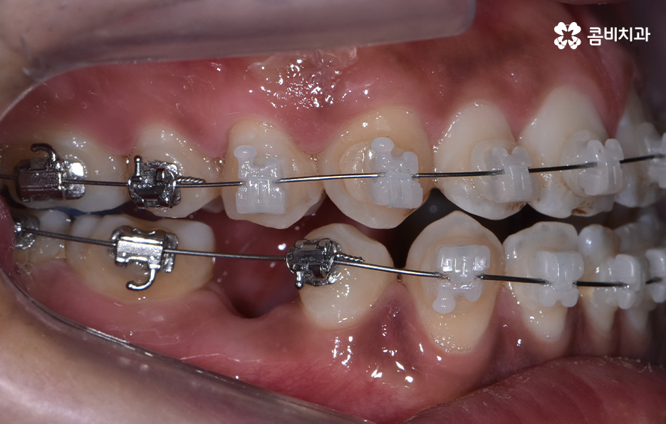 성인 부정교합 교정 더는 미루고 싶지 않다면 관련 이미지 5