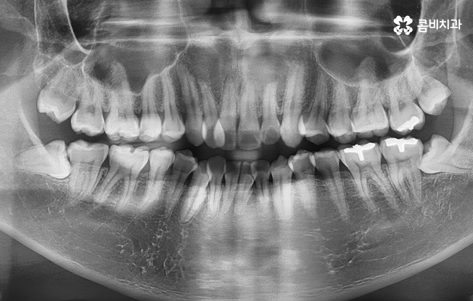 덧니 발치 교정 현명하게 선택하려면 관련 이미지 1