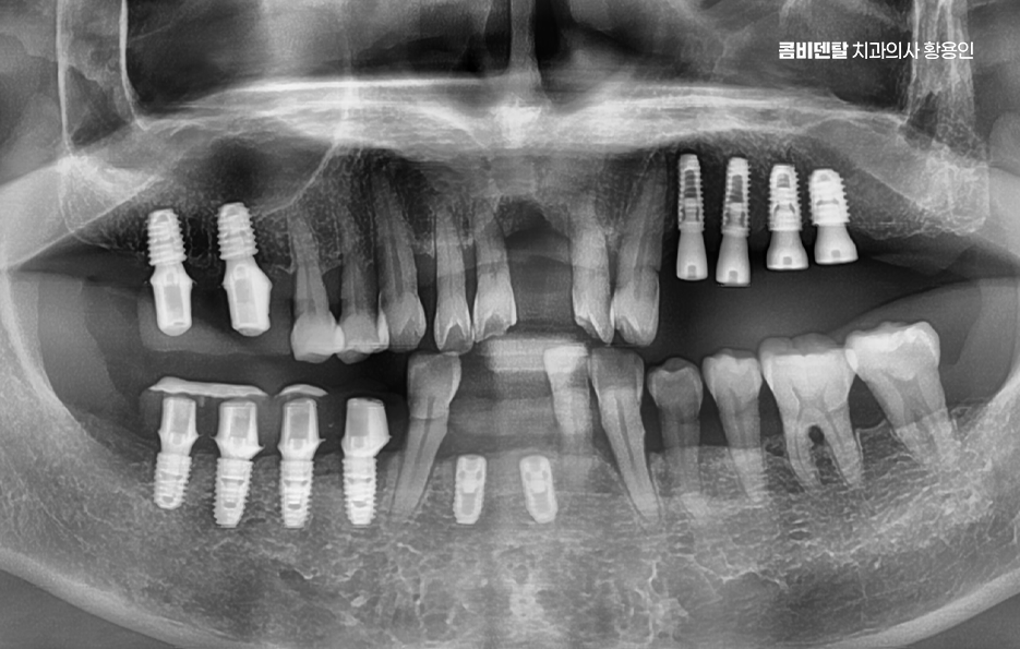 임플란트 뼈이식 안하면 어떤 문제가 있는거죠 관련 이미지 11
