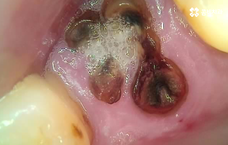 노인임플란트 이때부터 특히 조심하세요 관련 이미지 6