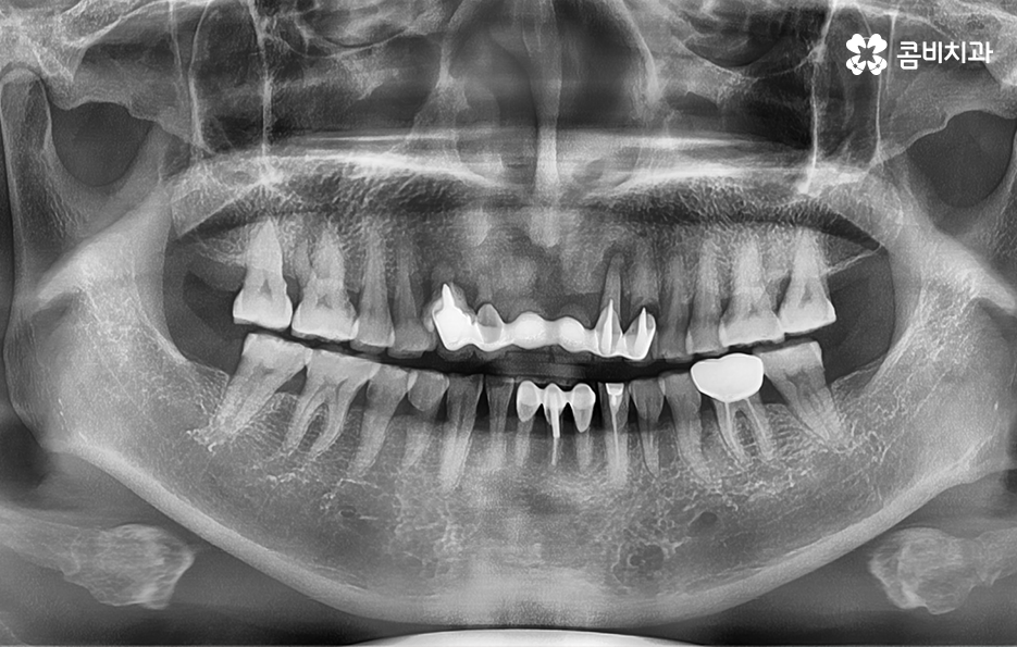 앞니임플란트 이런 조건들을 따져보세요 관련 이미지 1