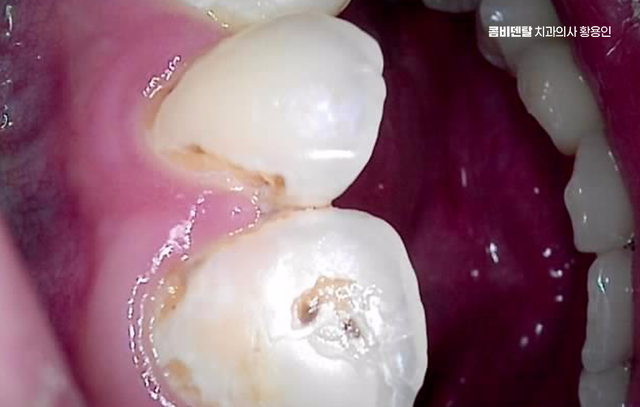 치아 시림 통증 갈수록 심해지다면 관련 이미지 3