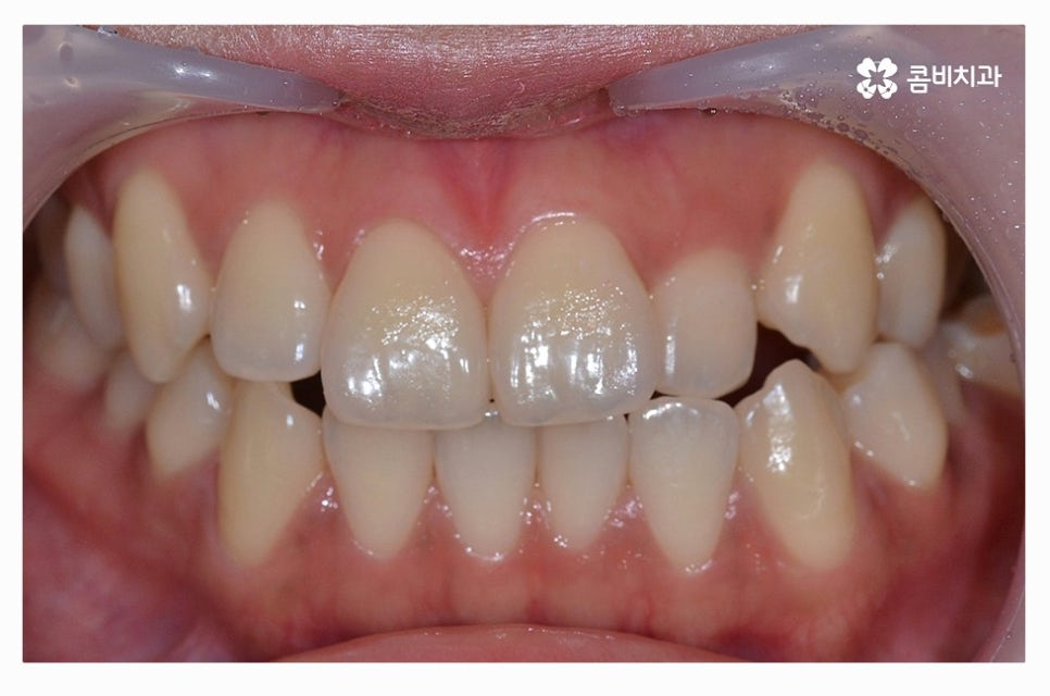 덧니교정 정교하게 따져보려면 관련 이미지 1