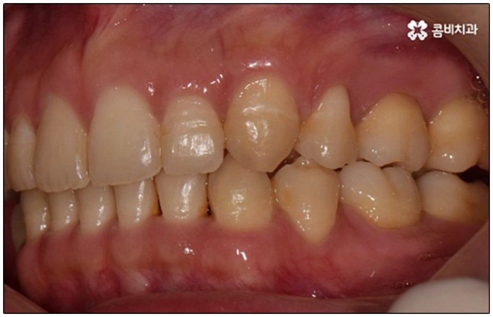 클리피씨교정 알아봐야 할것들 관련 이미지 11