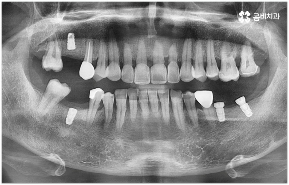 뼈이식임플란트 언제하나요? 관련 이미지 13