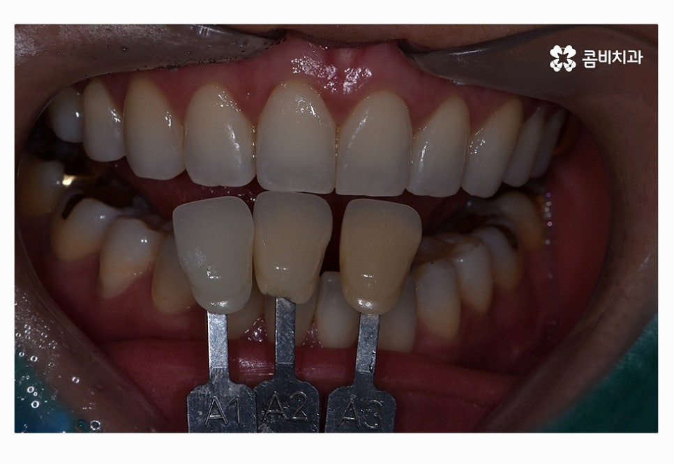 누런이로 고민하시는 분들을 위한 치아미백 정보 관련 이미지 1